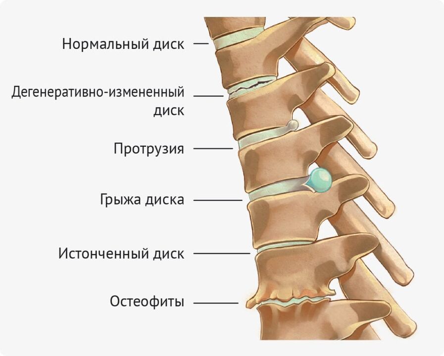 Disk deformities for lumbar osteochondrosis