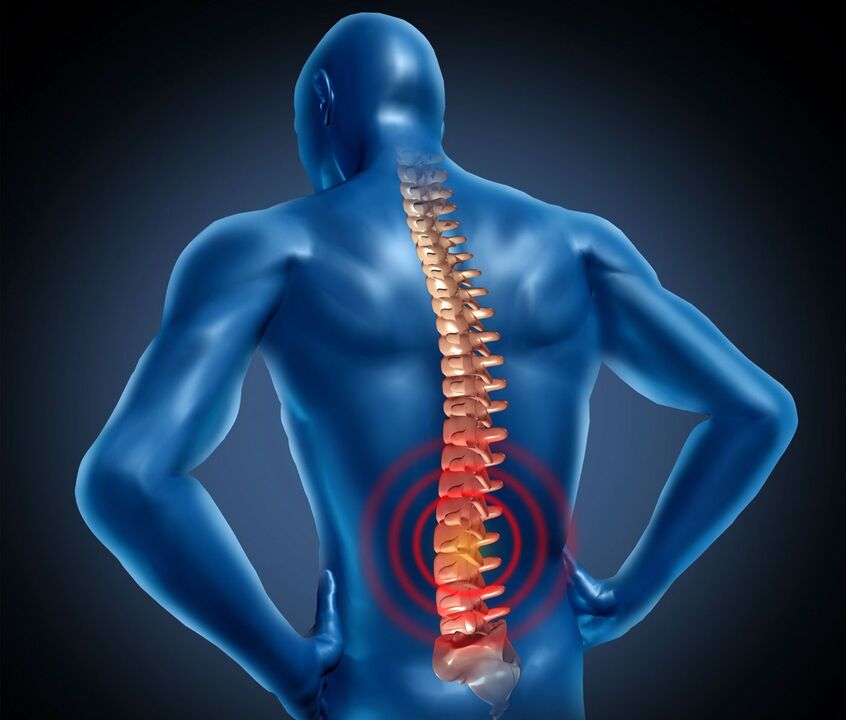 Lumbar osteochondrosis