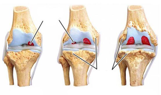 degree-arthrosis