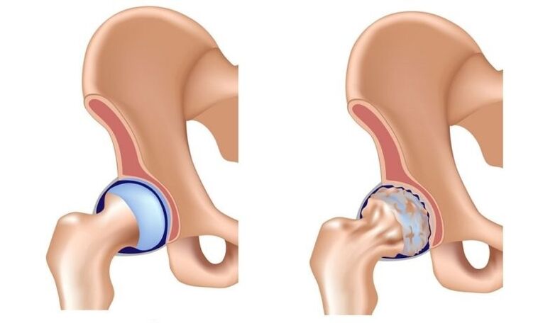 Healthy joint and joint with arthrosis