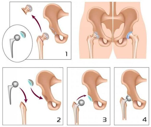 Replacing a sore joint with a prosthesis