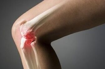 arthrosis of the knee joint is a lesion of cartilage tissue