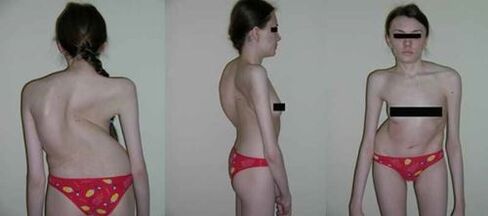 curvature of the spine as a consequence of osteochondrosis