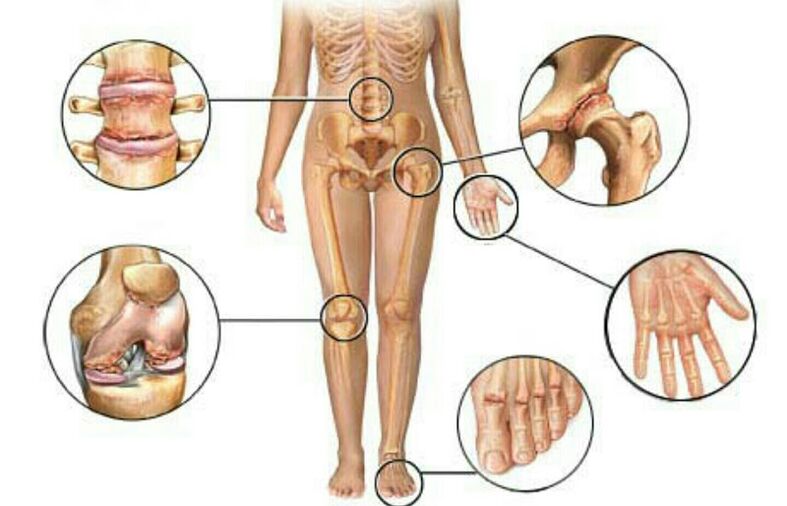 types and degrees of arthrosis