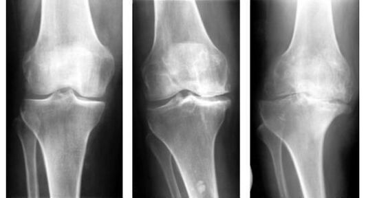 A mandatory diagnostic measure when identifying arthrosis of the knee is an x-ray