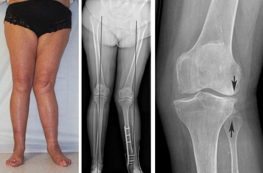 Advanced arthrosis of the knee joints is clearly visible visually even without x-rays