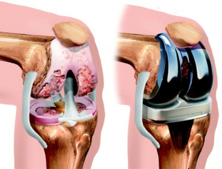 In case of total damage to the knee joint by arthrosis, it can be restored by endoprosthetics